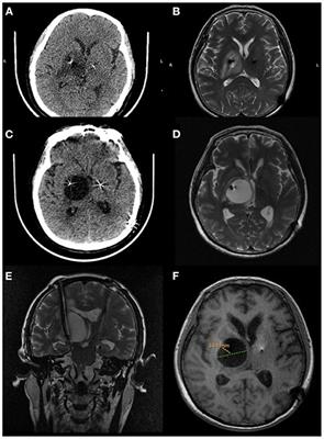 Development of Unilateral Peri-Lead Edema Into Large Cystic Cavitation After Deep Brain Stimulation: A Case Report